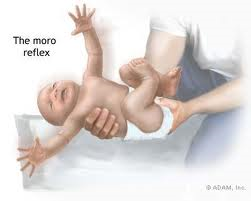 moro reflex